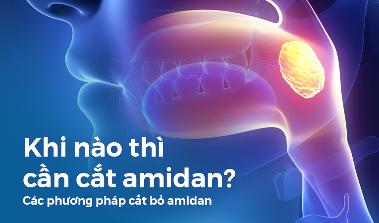 Khi nào thì cần cắt amidan? Cách phương pháp cắt bỏ amidan hiện nay