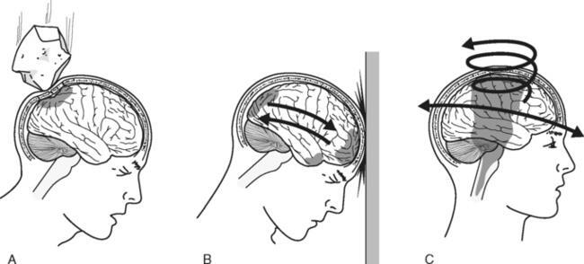 Nhận biết triệu chứng chấn thương sọ não nhẹ và cách điều trị