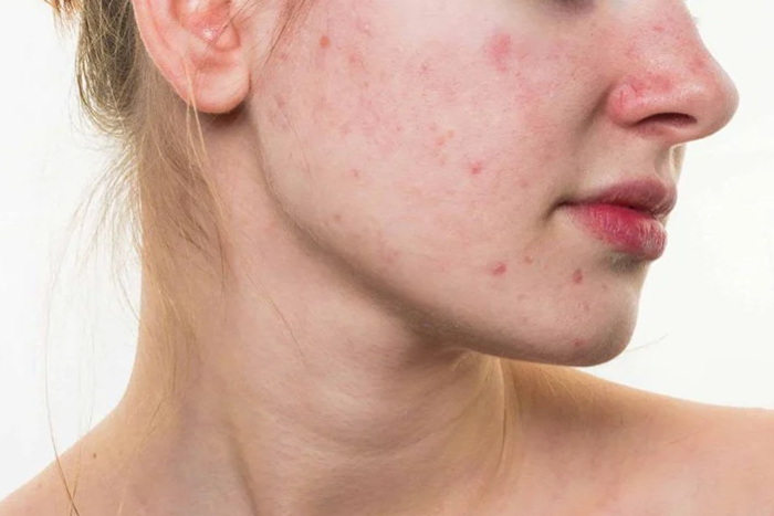 Da bị kích ứng: Dấu hiệu nhận biết và biện pháp khắc phục