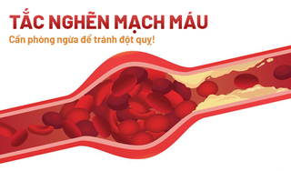 Tắc nghẽn mạch máu – Cần phòng ngừa để tránh đột quỵ!