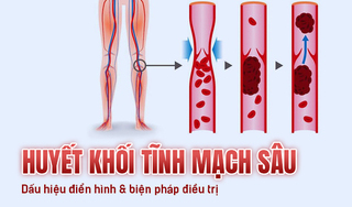 Huyết khối tĩnh mạch sâu Các dấu hiệu điển hình và biện pháp điều trị