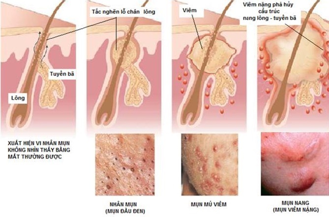 Nguyên nhân và các biện pháp điều trị mụn nang hiệu quả