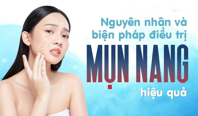 Nguyên nhân và các biện pháp điều trị mụn nang hiệu quả