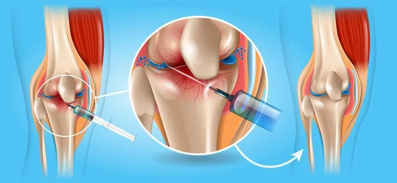 Gai khớp gối gây đau đớn: Cần xác định nguyên nhân để phòng ngừa