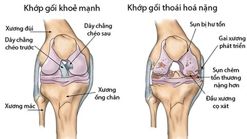 Gai khớp gối gây đau đớn: Cần xác định nguyên nhân để phòng ngừa