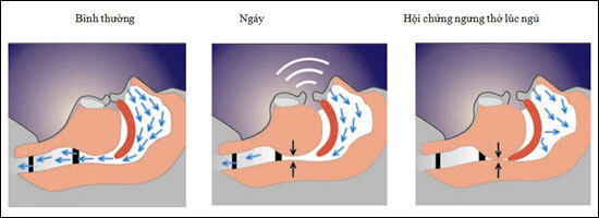 Ngủ ngáy: Liệu có khó khắc phục như vẫn nghĩ?