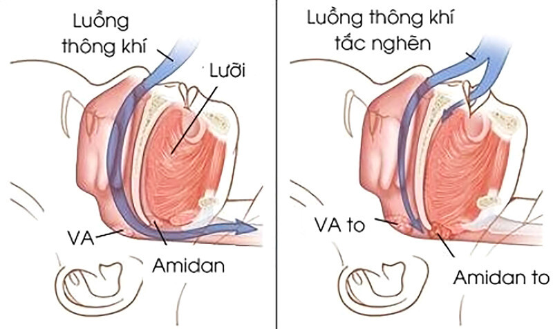 Ngủ ngáy: Liệu có khó khắc phục như vẫn nghĩ?