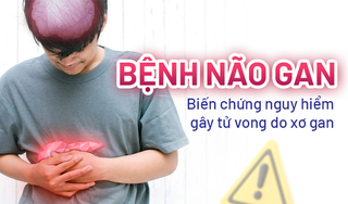 Bệnh não gan: Biến chứng nguy hiểm gây tử vong do xơ gan