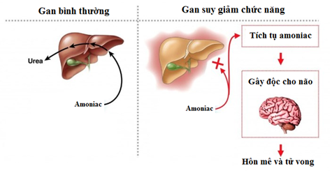 Bệnh não gan: Biến chứng nguy hiểm gây tử vong do xơ gan