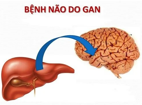 Bệnh não gan: Biến chứng nguy hiểm gây tử vong do xơ gan