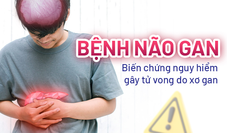 Bệnh não gan: Biến chứng nguy hiểm gây tử vong do xơ gan