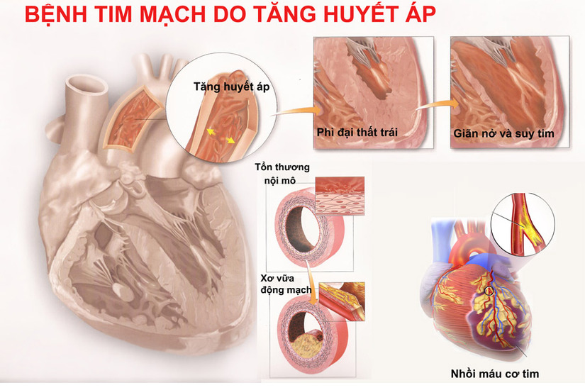 Hướng dẫn xử trí nhanh tình trạng tăng huyết áp đột ngột