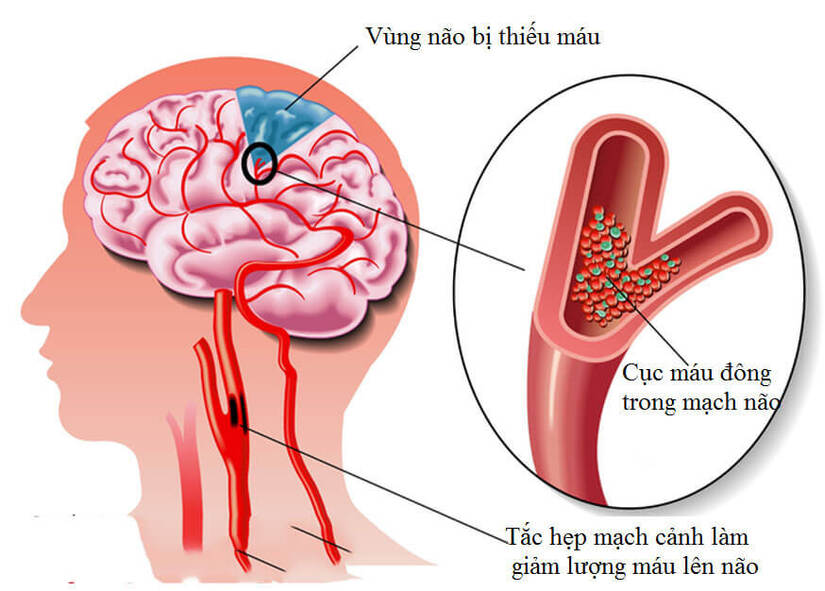 Hiểu rõ về tai biến mạch máu não do thiếu máu não cục bộ