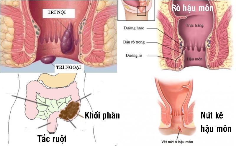 Táo bón ở người cao tuổi: Chớ chủ quan!