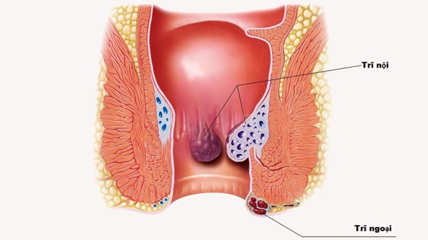 Giải đáp nhanh: Bệnh trĩ nội hay trĩ ngoại nguy hiểm hơn?