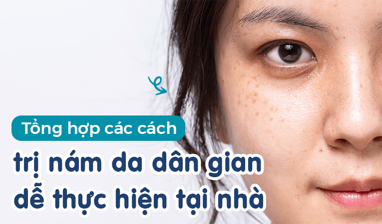 Tổng hợp các cách trị nám da dân gian dễ thực hiện tại nhà