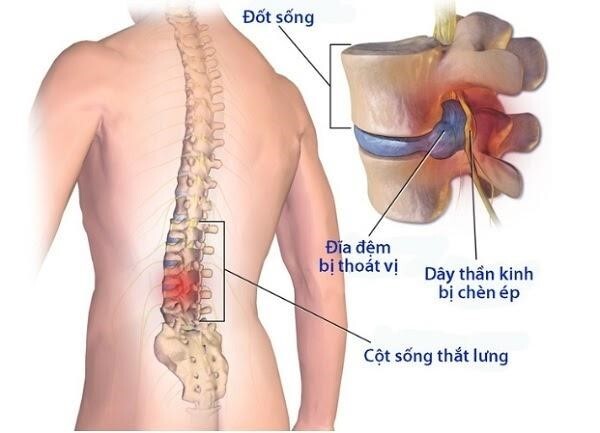 Đau thắt lưng ở nam giới: Cẩn trọng với những vấn đề sức khỏe