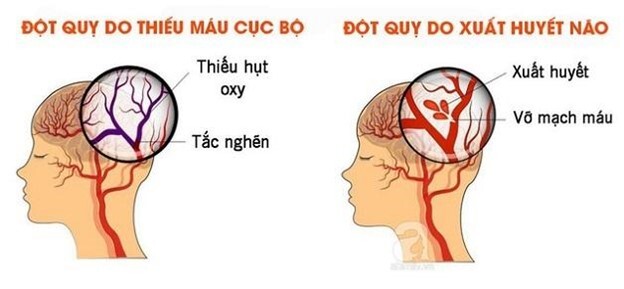 Tắm khuya bị đột quỵ có đúng không, làm sao để phòng ngừa?