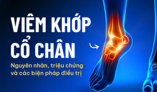 Viêm khớp cổ chân: Nguyên nhân, triệu chứng và các biện pháp điều trị