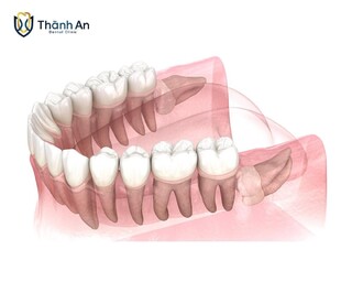 Răng số 8 mọc ngang: Nguy cơ tiềm ẩn và giải pháp xử lý hiệu quả