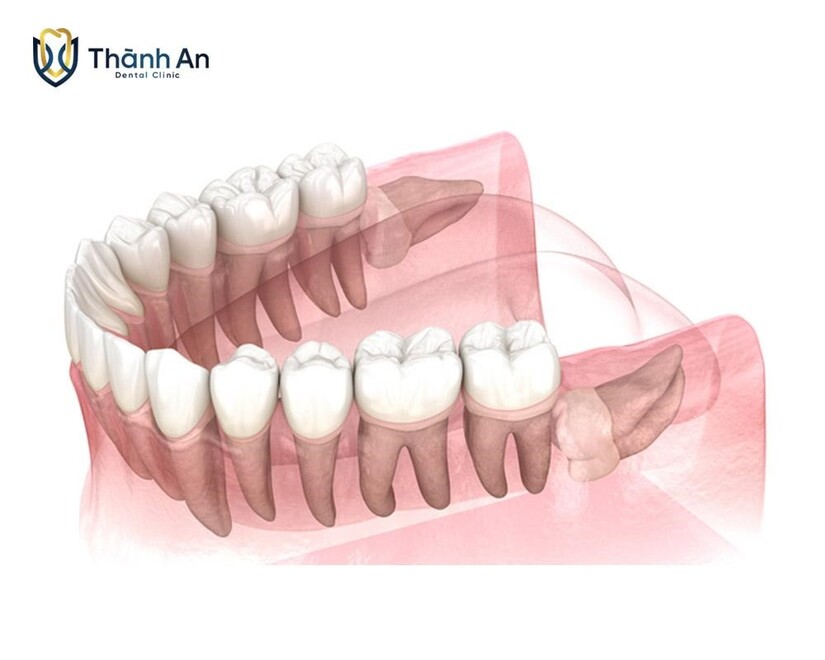 Răng số 8 mọc ngang: Nguy cơ tiềm ẩn và giải pháp xử lý hiệu quả