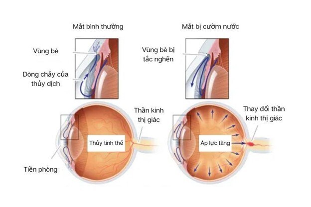 Bệnh cườm nước: Nguyên nhân hàng đầu gây mất thị lực và mù lòa