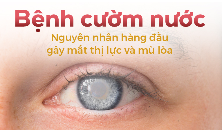 Bệnh cườm nước: Nguyên nhân hàng đầu gây mất thị lực và mù lòa