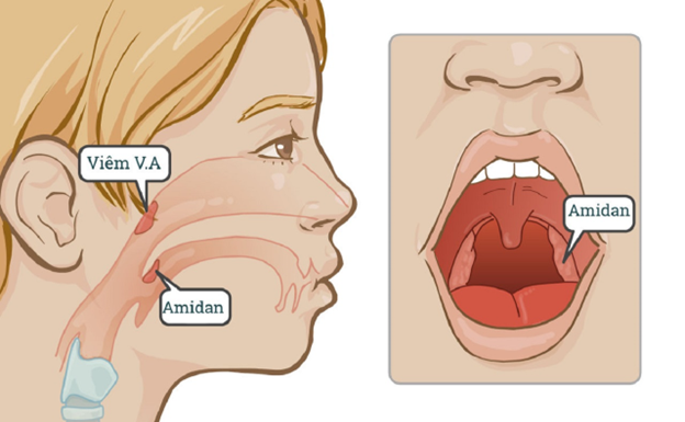 Viêm VA quá phát là gì? Triệu chứng và các biện pháp điều trị