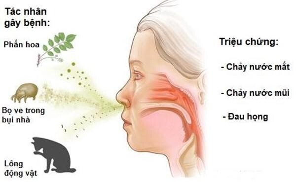 Viêm xoang dị ứng thời tiết: Triệu chứng và biện pháp điều trị