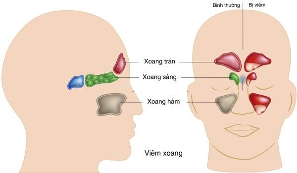 Viêm xoang dị ứng thời tiết: Triệu chứng và biện pháp điều trị