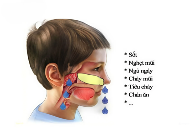 Làm thế nào để đối phó với triệu chứng viêm mũi mủ ở trẻ em?