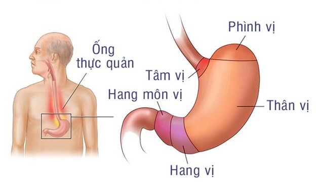 Thường xuyên sôi bụng về đêm Rất có thể bạn đang mắc phải bệnh lý này