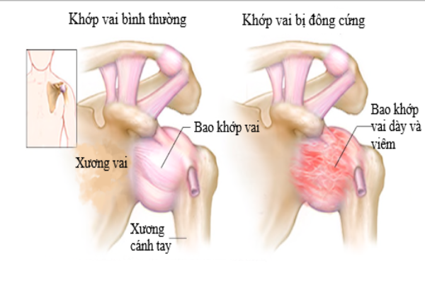 Các triệu chứng, biện pháp giảm đau viêm quanh khớp vai thể đông cứng