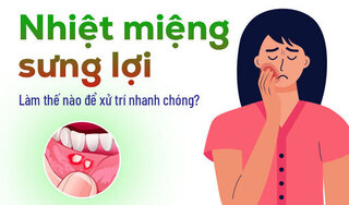 Nhiệt miệng sưng lợi: Làm thế nào để xử trí nhanh chóng?