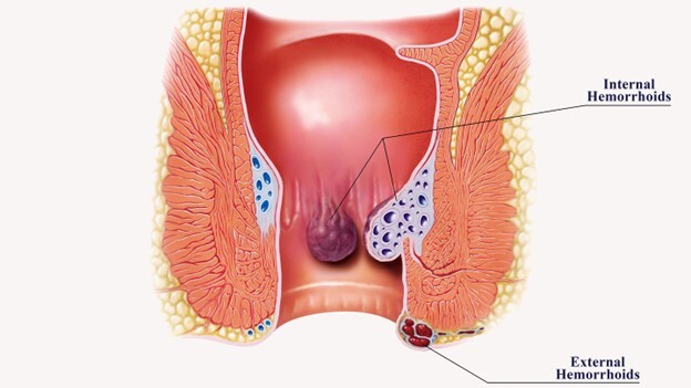 Giải đáp thắc mắc: Trĩ nội có tự hết không?