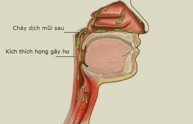 Nước mũi chảy xuống họng gây ho kéo dài: Phải làm sao?