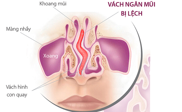 Nước mũi chảy xuống họng gây ho kéo dài: Phải làm sao?