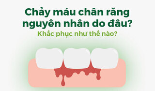 Chảy máu chân răng nguyên nhân do đâu? Khắc phục như thế nào?