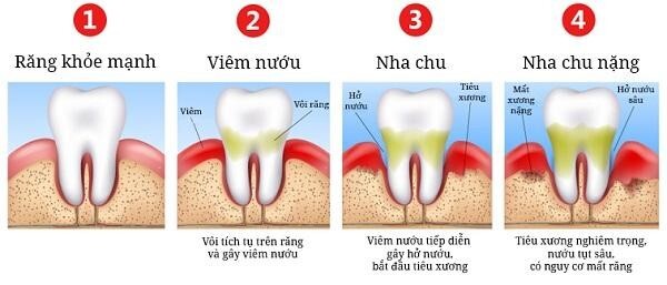 Chảy máu chân răng nguyên nhân do đâu? Khắc phục như thế nào?