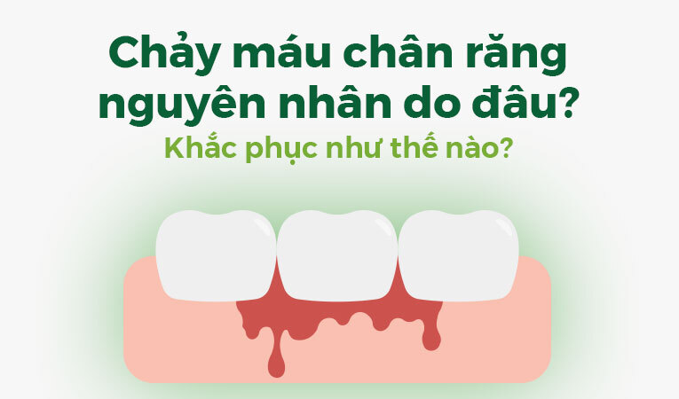 Chảy máu chân răng nguyên nhân do đâu? Khắc phục như thế nào?