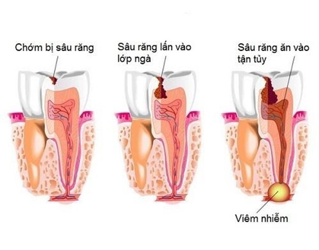 Đau răng bấm huyệt nào? Cách bấm huyệt giảm đau răng
