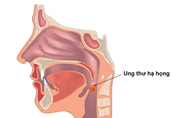 Giải thích nguyên nhân gây ngứa họng khó thở và cách khắc phục