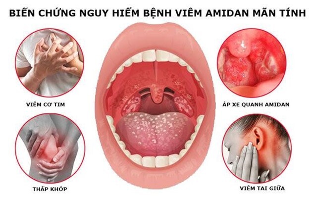 Viêm amidan cấp độ 2: Triệu chứng, tiến triển bệnh và biện pháp