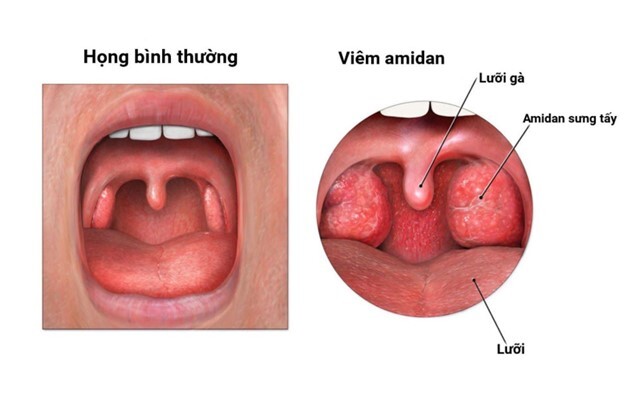 Viêm amidan cấp độ 2: Triệu chứng, tiến triển bệnh và biện pháp