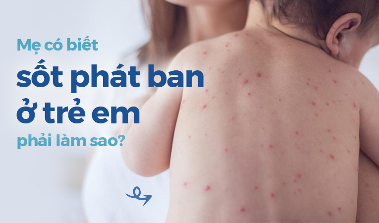 Mẹ có biết sốt phát ban ở trẻ em phải làm sao?