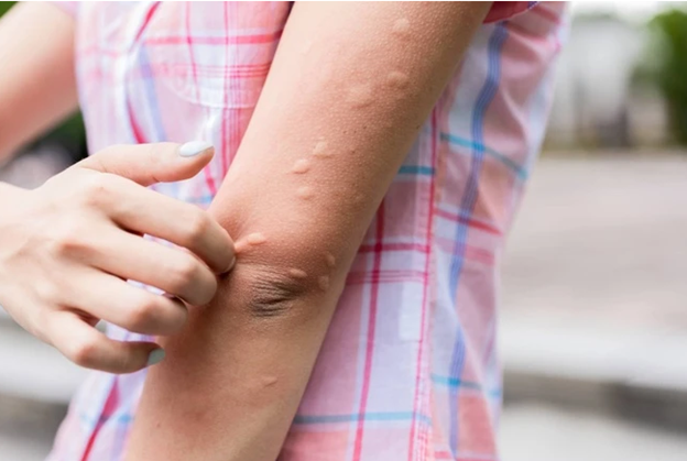 Muỗi đốt sưng đỏ: Cách giảm ngứa và nhanh lành da