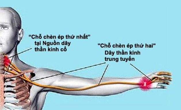 Hội chứng cổ vai cánh tay: Làm sao để đối phó với nỗi ám ảnh?