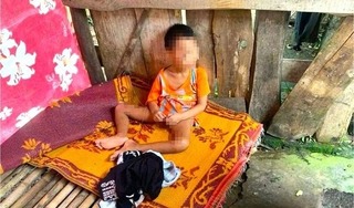Bé 5 tuổi cơ thể có nhiều vết thương lở loét bị đưa ra ở riêng trong lán tạm 