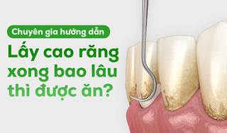 Chuyên gia hướng dẫn: Lấy cao răng xong bao lâu thì được ăn?