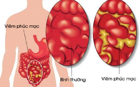 Điều trị co cứng thành bụng viêm phúc mạc như thế nào?